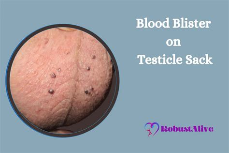 hard spot on testes|small lump on testicle sack.